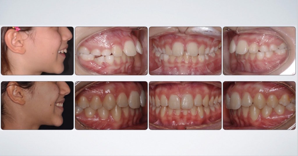 denti sporgenti 2 classe