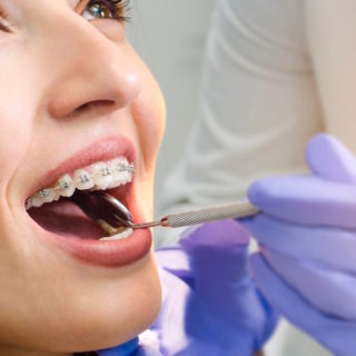 trattamenti ortodontici adulti