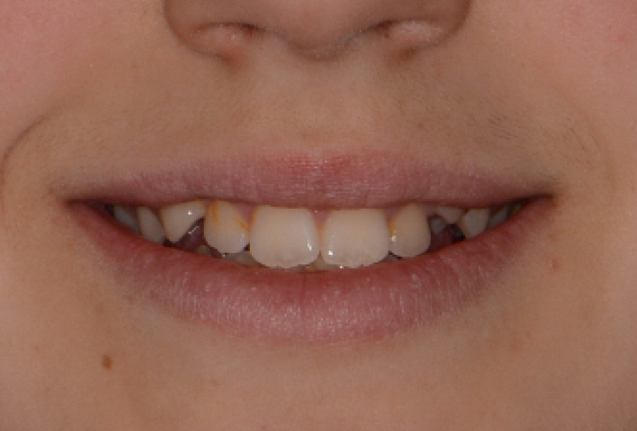 il sorriso di Adele prima