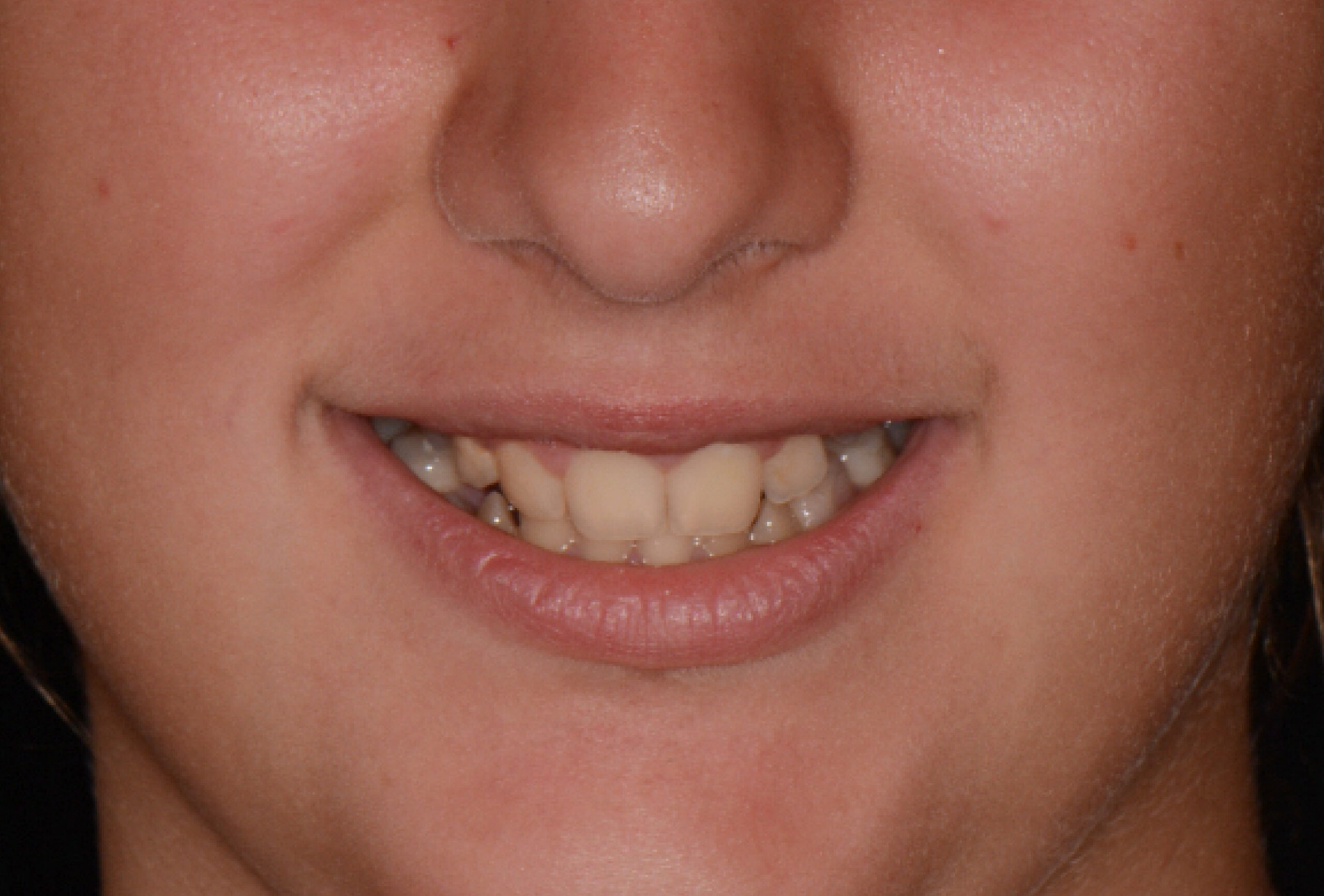 il sorriso di Serena prima